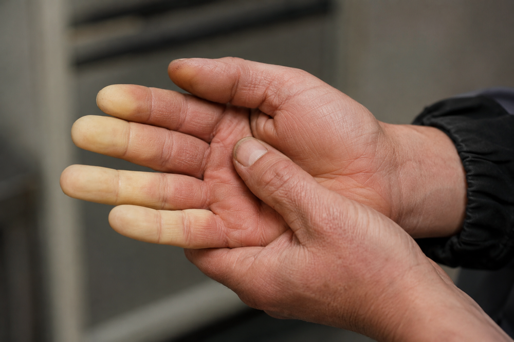 Worker's fingers showing white blanching, an early symptom of HAVS